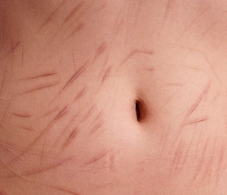 female abdomen with scars from self harm for article Understanding Self-Harm by Nsight Mental Health & Wellness